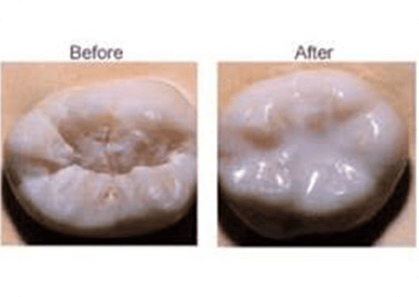 Dental Sealants (Cavity Prevention)