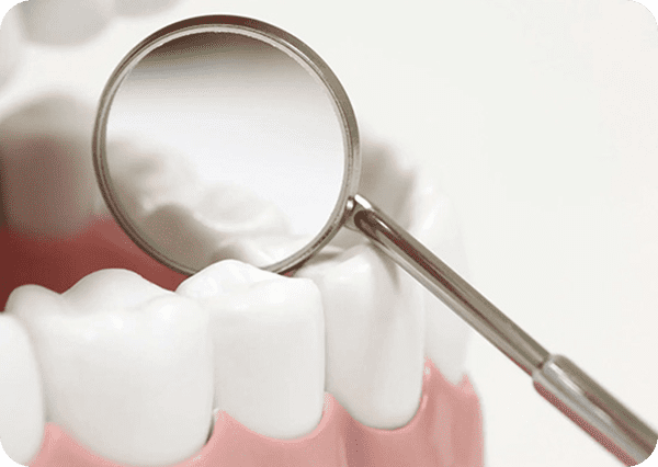 Temporary Filling (IST) 