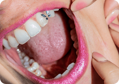 Swarovski Tooth Crystals